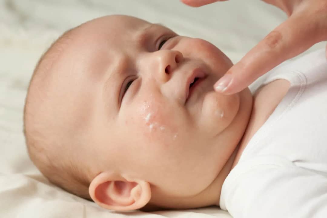 Skaza białkowa czy potówki u niemowlaka? Rozpoznaj bezbłędnie!